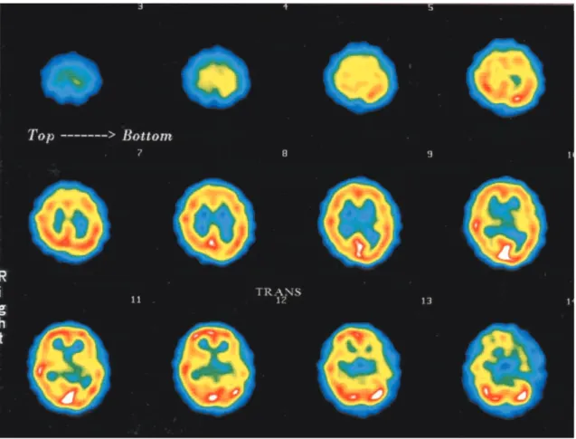 Fig. 2. Example of SPECT data in HFA. These data were obtained from a 13-year-old male