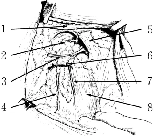 Fig. 1. Diagram of the axillary region after lower axillary dissection (right side) 1