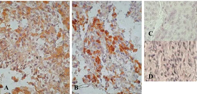 Table 1. The score of MMP-2 and MMP-9 expression in invasive and noninvasive pituitary adenomas