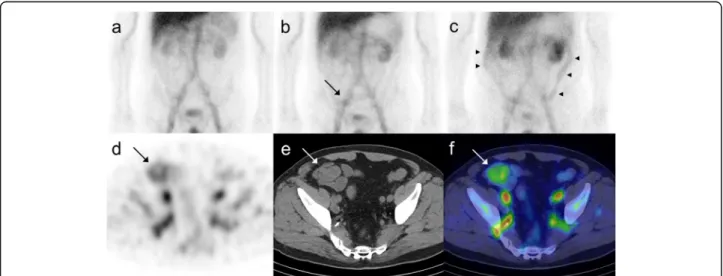 Fig. 1 Planar + SPECT/CT of the representative patient where the site of bleeding could be detected