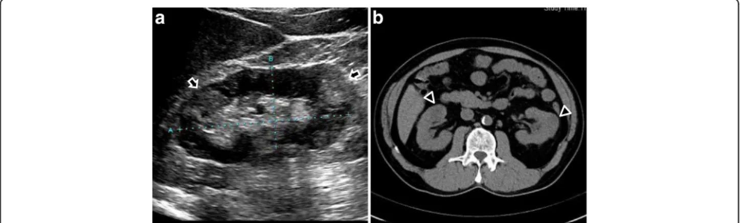 Fig. 1 Findings of Echography and computed tomography before treatment. (a) Multiple high echoic lesions ( arrows ) by Echography and (b) mass-like regions ( arrow head ) by computed tomography