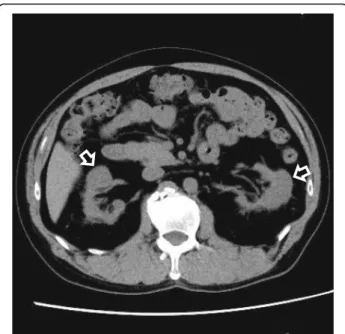 Fig. 4 Findings of computed tomography after treatment. Focal atrophy of kidneys. Mass-like regions before treatment did not show atrophic change by computed tomography