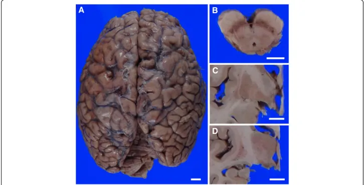 Fig. 2 Macroscopic findings. The precentral gyrus showed mild atrophy (a). Depigmentation of the substantia nigra and atrophy of the tegmentum was observed in the midbrain (b)