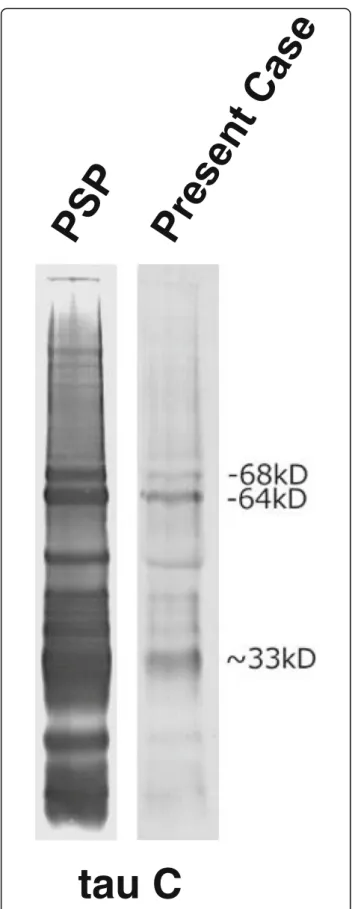 Fig. 4 Immunoblot analysis of sarkosyl-insoluble tau. Full-length hyperphosphorylated tau bands indicated by 64, 68 kD and ~ 33 kDa fragments were detected, consistent with a progressive supranuclear palsy tau banding pattern