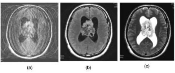 Fig. 1 : The utility of the “Propeller Technique” in an unstable subject with central neurocytoma