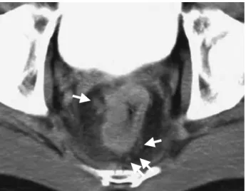 Fig. 3 : Resected specimen. A type 4 shaped tumor was located in the rectum.