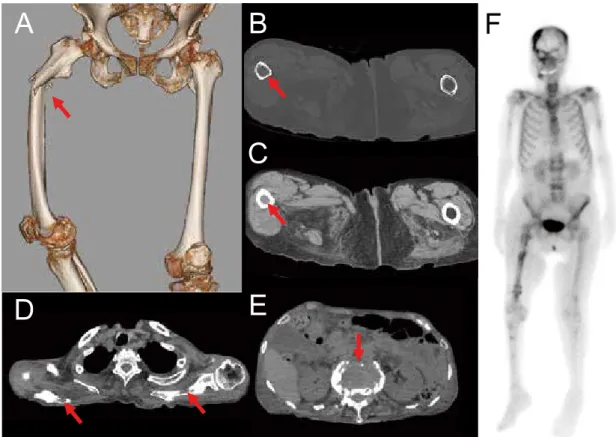 Figure 1. 　Computed tomography showing fracture of the right femoral shaft (A : arrow), the thin bone cortex (B : arrow)  filled with a high-intensity tumor (C : arrow) at the fracture site, and osteolytic tumors in the bilateral scapula (D: arrow)  and lu
