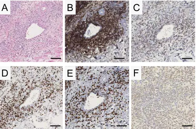 Figure 3. 　Hematoxylin and eosin staining (A) of the biopsy obtained from the head tumor showing diffuse growth  patterns with large cells