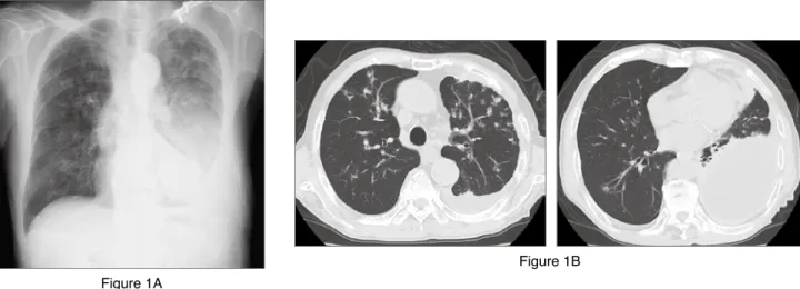 Figure 1. 　Chest X-ray and Chest CT on admission. Bilateral infiltrative shadows and left massive pleural effusion were evident in chest  X-ray (Figure 1A)