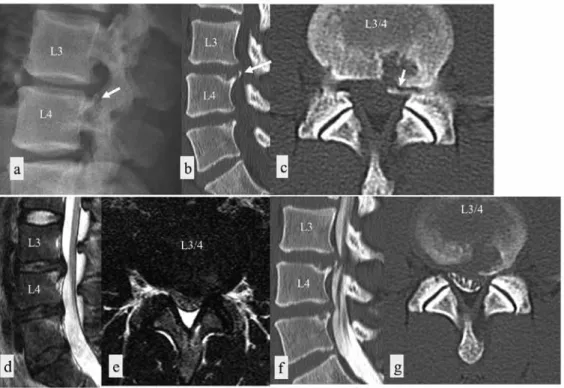 Fig 4 shows the radiologic findings after surgery. The bony Figure 1