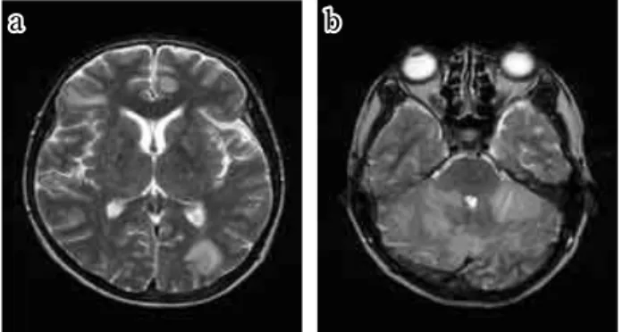 Fig. 2. T2-weighted MRI images. The condition of the two im- im-ages has been unified in terms of the window width