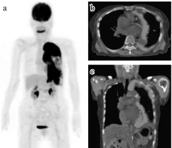 Fig. 2 Fifty - five year - old male. a) MIP image of FDG - PET.