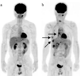 Fig. 3 Fifty - one year - old male. a) PET image at initial diagno- diagno-sis. FDG - PET/CT demonstrated a slight diffuse uptake along the pleura