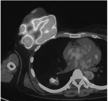 Fig． １：初診時 PET/CT では右乳房腫瘤に SUVmax ２ ５． ９ ０の FDG 集積を認めた。多発肺転移を疑う腫瘤も認めた。 Fig． ２：仙骨にSUVmax １ ７． ０ ６のFDG集積を認めるなど腸骨や右 大腿骨などに多発骨転移を認めた。 Fig． ３：EC ２コース終了時 CT では多発肝転移の出現を認めた。 Fig． ４：多発肺転移は明らかに増悪しており，病勢進行と判断した。武 知浩 和他１７０