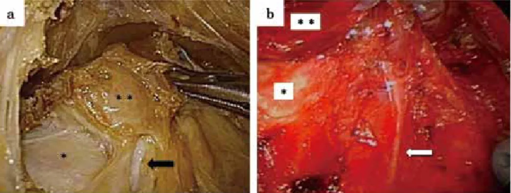 Table 2. 　Five patients in which hemi-thyroidectomy was performed using VANS