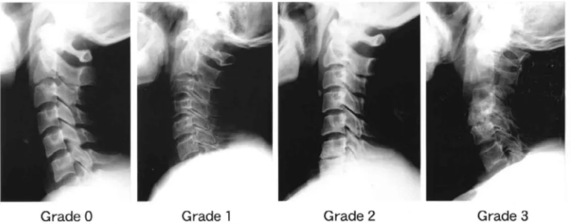 Figure 5 shows radiological changes of a 65 years old male pa- pa-tient who has been managed with hemodialysis during 8 years at
