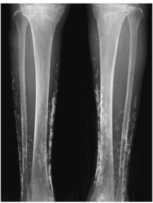 Fig. 4. Histopathological examination revealed that the white mass was calcification.