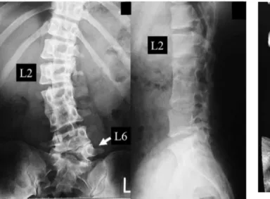 Figure 3. Three - dimensional computed tomography scans of the lumbar spine.