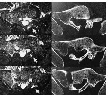 Figure 5. Axial images of L6 - S1 on short tau inversion recovery mag- mag-netic resonance imaging (left panel) and computed tomography (right panel).