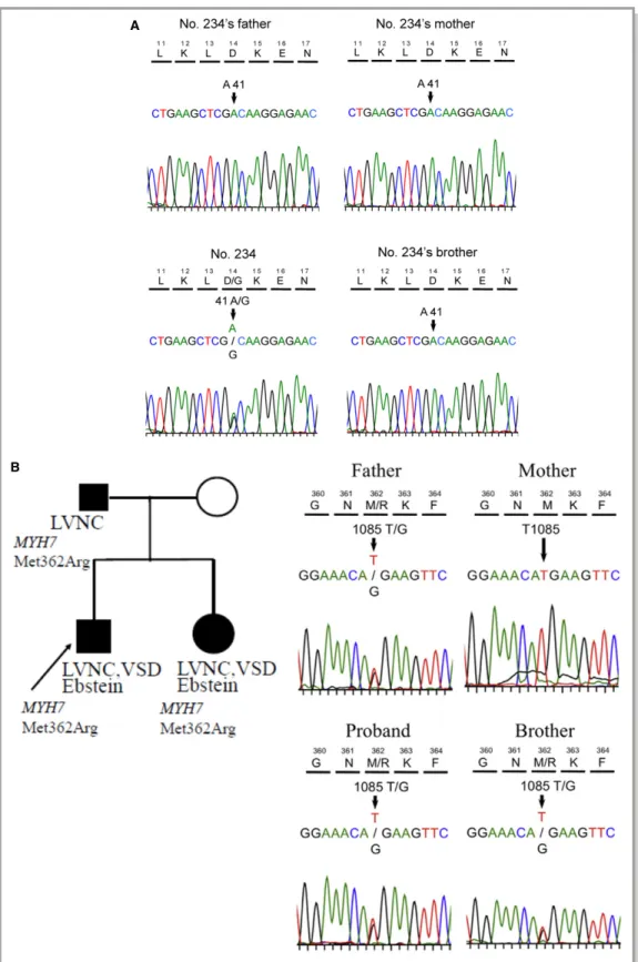 Figure 5. A, De novo variant of TPM1 c.41A&gt;G (p. D14G) in an LVNC family. B, Familial LVNC and Ebstein anomaly associated with the MYH7 c.1085T&gt;G p.Met362Arg