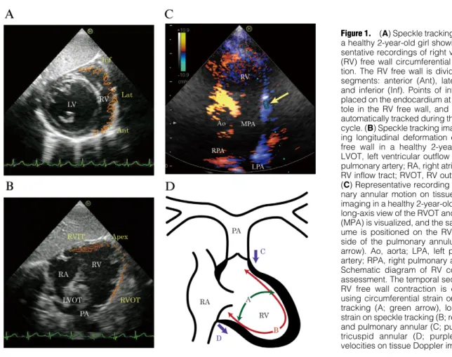 Figure 1.  (A) Speckle tracking image of  a healthy 2-year-old girl showing  repre-sentative recordings of right ventricular  (RV) free wall circumferential  deforma-tion