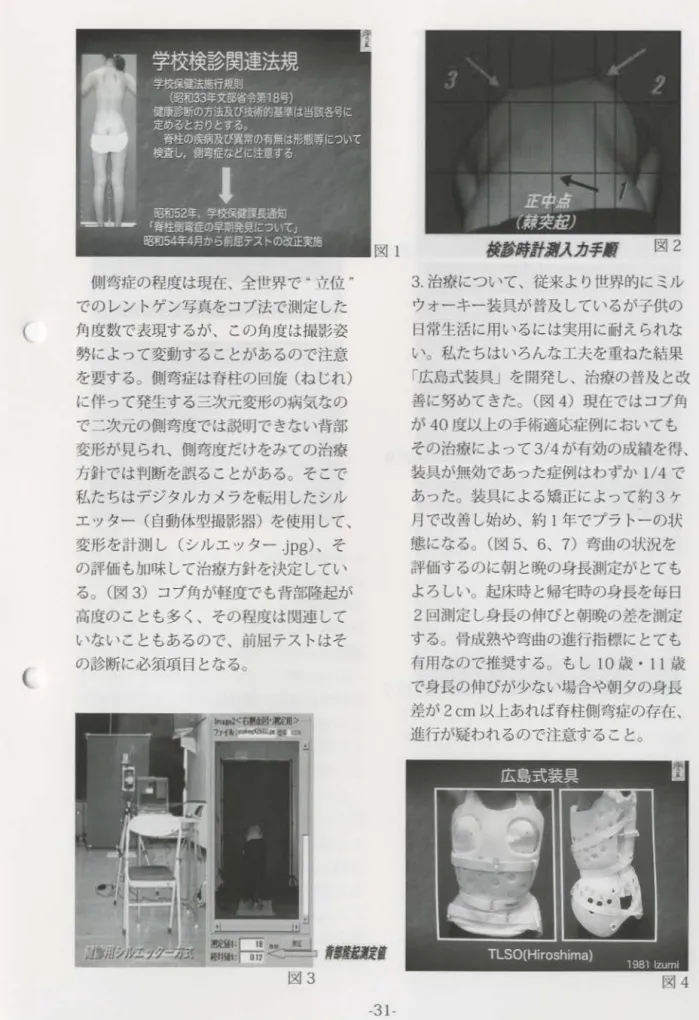 図 l l l l l # l f J I . λ 方手 ： . 図 2 側壁；痕の程度は現在、全町界で“立位句 でのレントゲン写真をコプ i l で測定した 角度数で表現するが、この角度は撮影姿 勢によって変動することがあるので注意 を要する。側室苦症は脊柱の f n j 旋（ねじれ） に伴って発生する三次元変形の病気なの で二次元の側膏度では説明できない背部 変形が見られ、側脅度だけをみての治療 ! J 針では判断を誤ることがある。そこで 私たちはデジタルカメラを転倒したシル エッター（自動体塑撮影間）