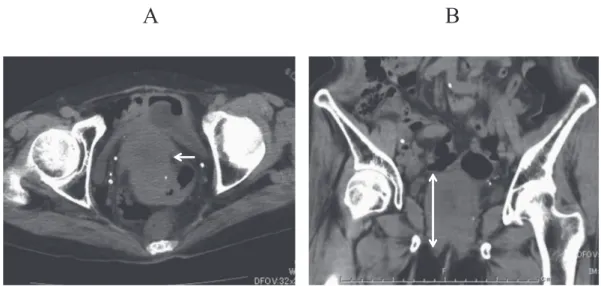 Figure 1. An abdominal CT scan detected a tumor in the ventral rectum (arrows).