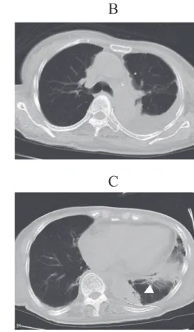 Figure 5. A cytological analysis resulted in a diagnosis of pulmonary adenocarcinoma ( ! 100)