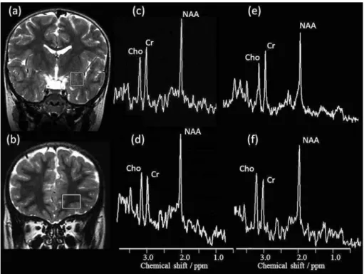 Fig. 1. Location of the measurement voxel in the left amygdala (a) and the left orbito - frontal cortex (OFC) (b) and representative spectra obtained