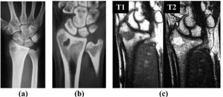 Figure 1 : (a) Radiograph showing radioluency in the right distal radius. (b) Computed tomography image showing osteolytic change in the distal radius