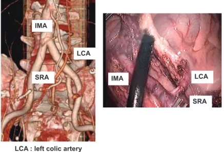 Figure 3. Surgical technique of central lymph nodes dissection. The root of the IMA is dissected with an ultrasonic cutting and coagulating sur- sur-gical device (LCS) to avoid bleeding