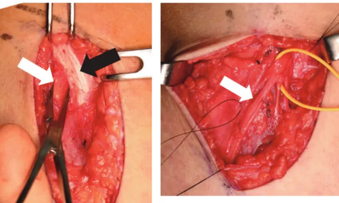 Fig. 1b : The lateral femoral cutaneous nerve was entrapped at the fascia lata of the thigh (white arrow).