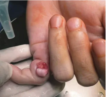 Figure 1 : Preoperative photograph showing open dislocation of the proximal interphalangeal joint of the little finger.