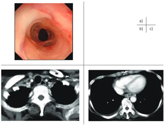Fig. 2 : Post - chomotherapeutic findings.