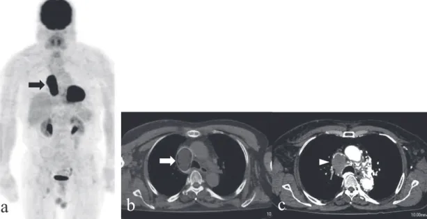 Fig. 5. A 74 - year - old man with SVC invasion of a large mediastinal B - cell lymphoma