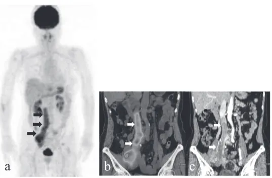 Fig. 6. A 63 - year - old woman with retroperitoneal leiomyosarcoma. (a) FDG - PET 3D MIP image, (b) coronal PET/CT fusion im- im-age and (c) coronal contrast- enhanced CT imim-age