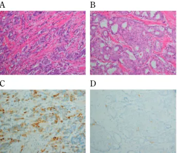 Table 1. Microscopic structural pattern and thrombospondin - 1 (TSP - 1) expression in invasive ductal carcinoma of the breast (n = 101) TSP - 1 expression Tumor with a non- or minimally desmoplastic component