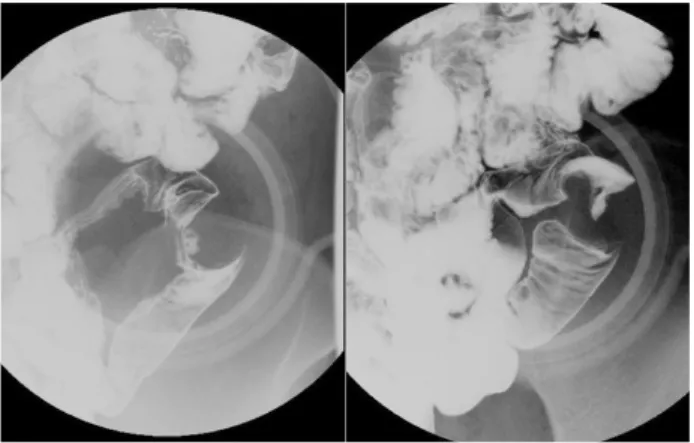 Fig. 5. Small intestinal fluoroscopy revealed an 2.5 cm submu- submu-cosal mass with a surface depression in the ileum.