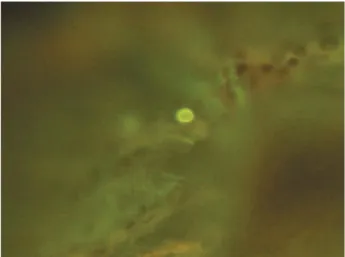 Fig. 5 Fungi flora Y " ! staining of Acanthamoeba cyst in corneal scraping in case 3 (original magnification 200 !)