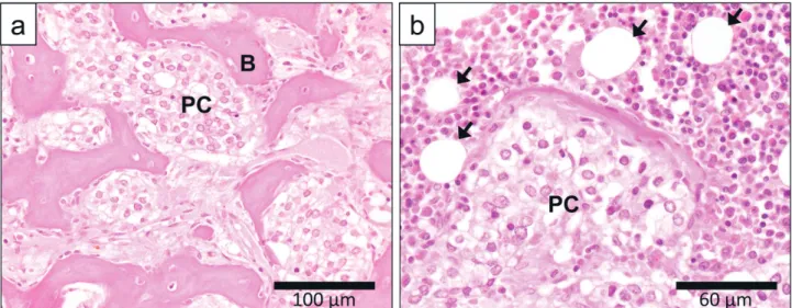 Figure 4. Interactions of prostate cancer cells with osteoblasts, osteo- osteo-clasts, and adipocytes in the microenvironment of bone metastases