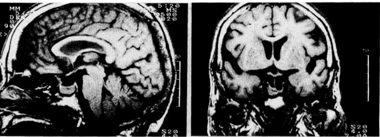 Fig.  2. Sagittal  (left)  and  coronal  (right)  T1-weighted  MR  scans  of  the  head