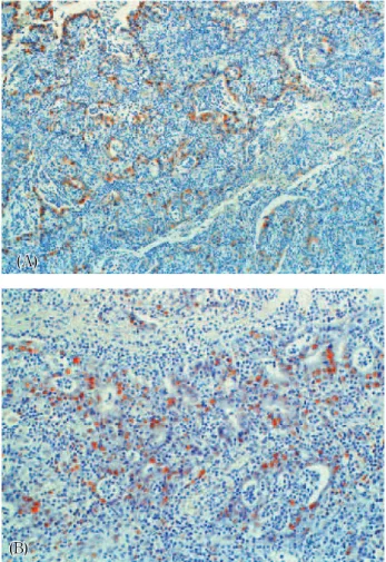 Fig. 3. Moderately differentiated adenocarcinoma with lymph node metastasis, intestinal type