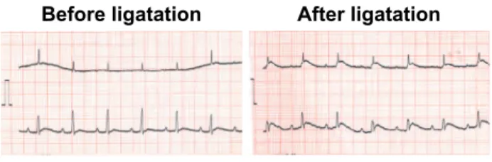 Fig. 1 shows an example of a limb-lead ECG be- be-fore and after ligation of the left anterior descending coronary artery on thoracotomy under artificial 