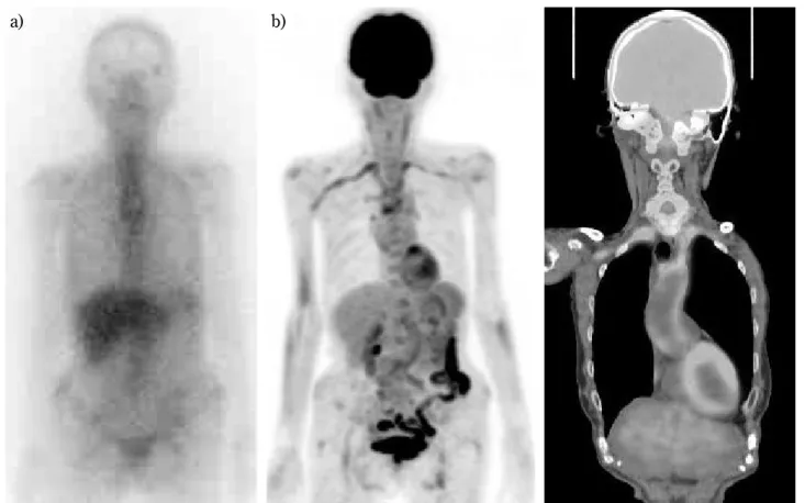 Fig. 1. A 77-year-old female. a) 67 Ga-citrate scintigraphy shows no abnormal uptake. b) MIP image of FDG-PET