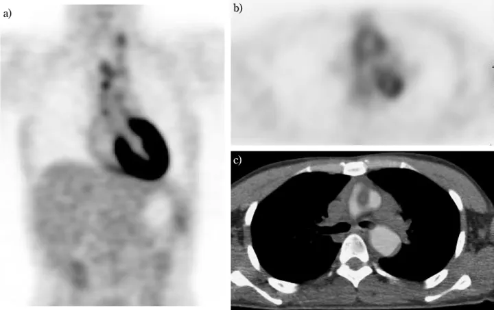 Fig. 3. A 32-year-old female. a) Coronal view of FDG-PET. b) Axial view of FDG-PET. c) Axial view of PET/CT image