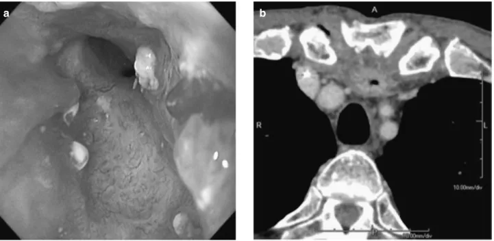 Fig. 2a An endoscopic finding after chemotherapy