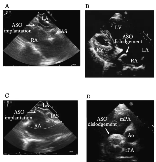 Figure 2. Echograms during the transcatheter ASD closure procedure