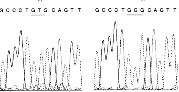 Fig. 4. DNA sequences in samples of bladder tumors. GTG (Val) to GGG (Gly) transversion at codon 141 of the p53 gene is shown.