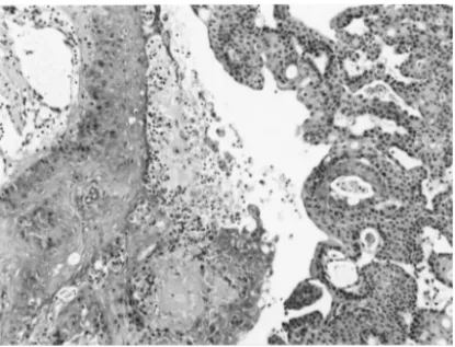 Fig. 5. Histology of a bladder tumor with a p53 mutation. TCC with moderately differentiated SCC (HE × 99).