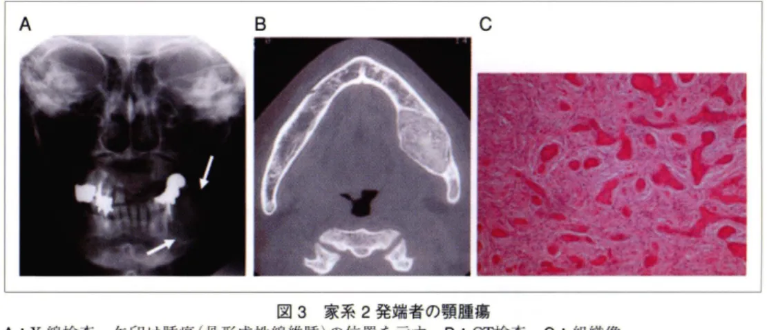 図 3 家系 2 発端者の顎腫蕩